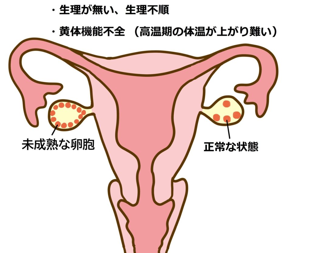 多嚢胞性卵巣症候群（PCOS）